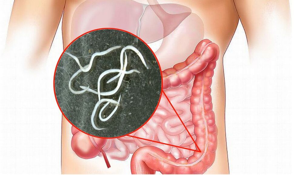 Parasitos no corpo humano sen tratamento