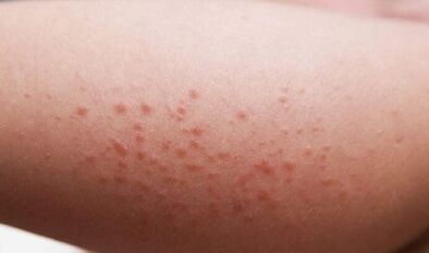 manifestacións externas da presenza de parasitos no corpo